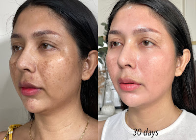 รีวิว ครีมทาฝ้า รักษาฝ้าแดด ฝ้าฮอร์โมน ฝ้าสะสมมา 10 ปี ด้วย cosmelan 1 และ cosmelan 2 จากประสบการณ์จริง