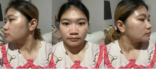 ของดีบอกต่อ ใช้แล้วว้าว บอกลารอยดำ!