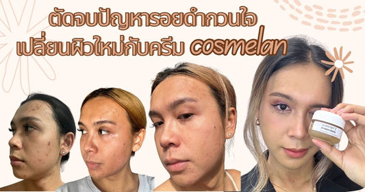 ตัดจบปัญหารอยดำกวนใจ เปลี่ยนผิวใหม่กับครีม cosmelan
