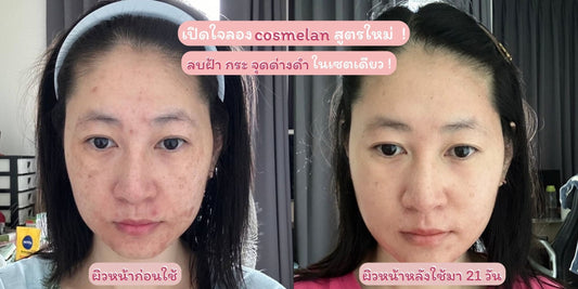 เปิดใจลอง Cosmelan สูตรใหม่ ลบฝ้า กระ จุดด่างดำ ในเซตเดียว !