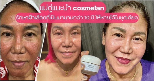 แม่ตู่แนะนำ Cosmelan รักษาฝ้าเลือดที่เป็นมานานกว่า 10 ปี ให้หายได้ในชุดเดียว