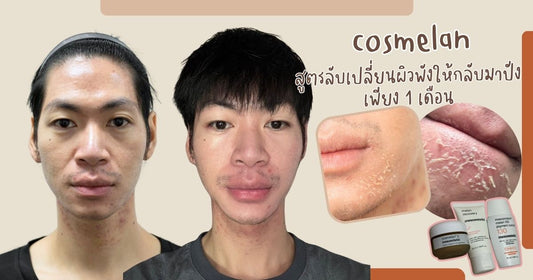 Cosmelan: สูตรลับเปลี่ยนผิวพังให้กลับมาปังเพียง 1 เดือน